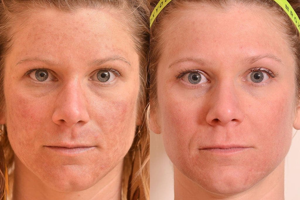 Ácido Retinóico para tratar Melasma Clínica Fit Body Estética