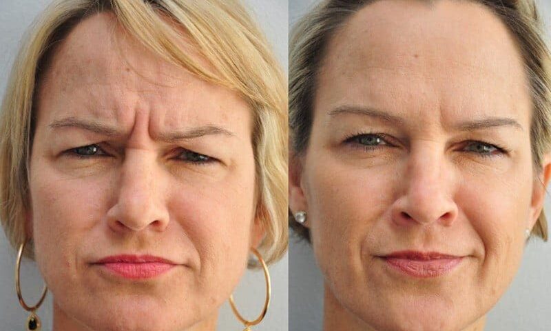 Botox Para Tratar As Rugas Entre As Sobrancelhas Fit Body Est Tica