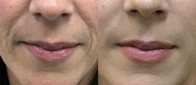 Remodelação dos Glúteos Clínica Fit Body Estética