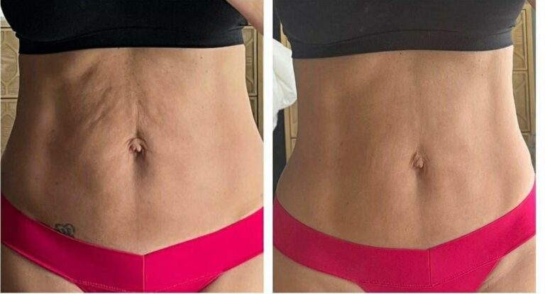 Flacidez Na Barriga Antes E Depois Cl Nica Fit Body Est Tica