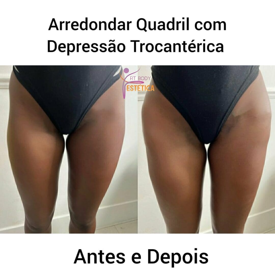 Arredondar Quadril Depress O Trocant Rica Fit Body Est Tica