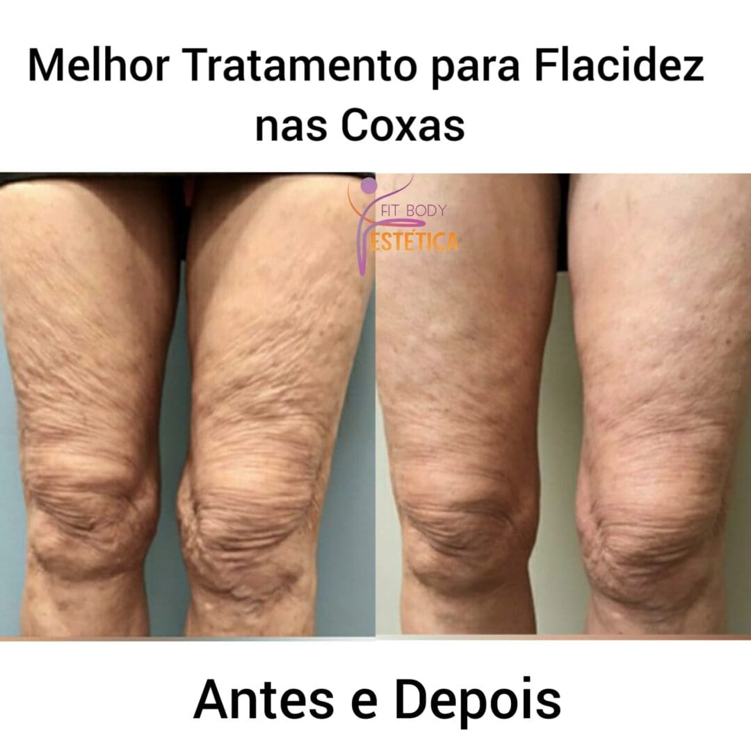 Melhor Tratamento para Flacidez nas Coxas Fit Body Estética