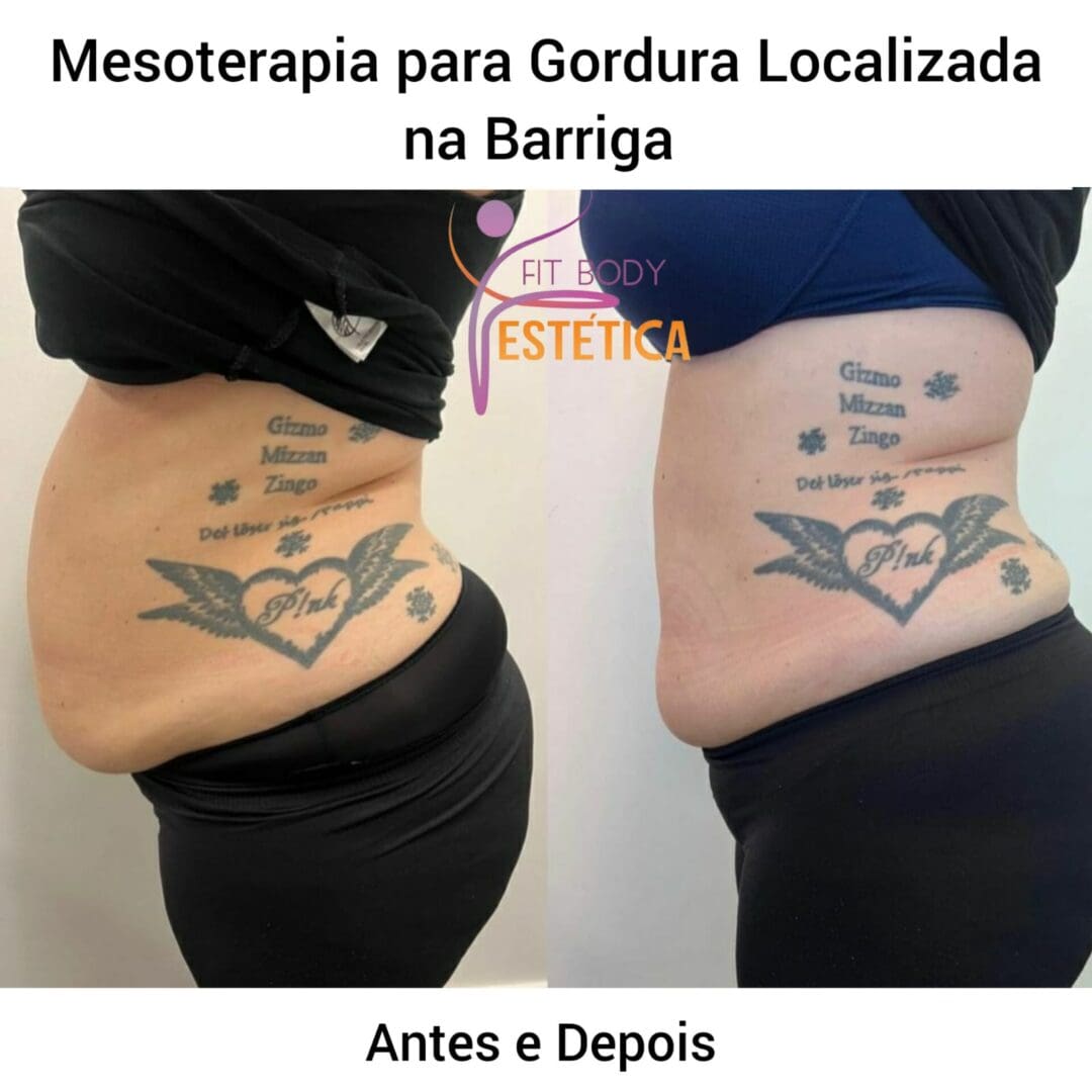 Mesoterapia Para Gordura Localizada Na Barriga Dra Sacha