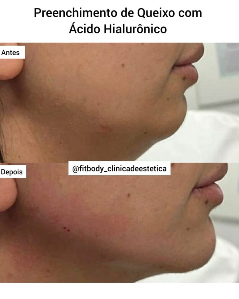 Preenchimento Queixo Antes e Depois Clínica Fit Body Estética