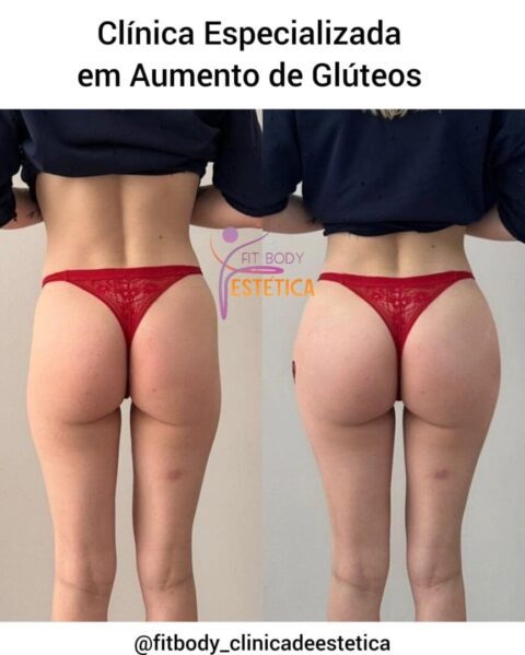 Aumento de Glúteos Clínica Especializada Clínica Fit Body Estética