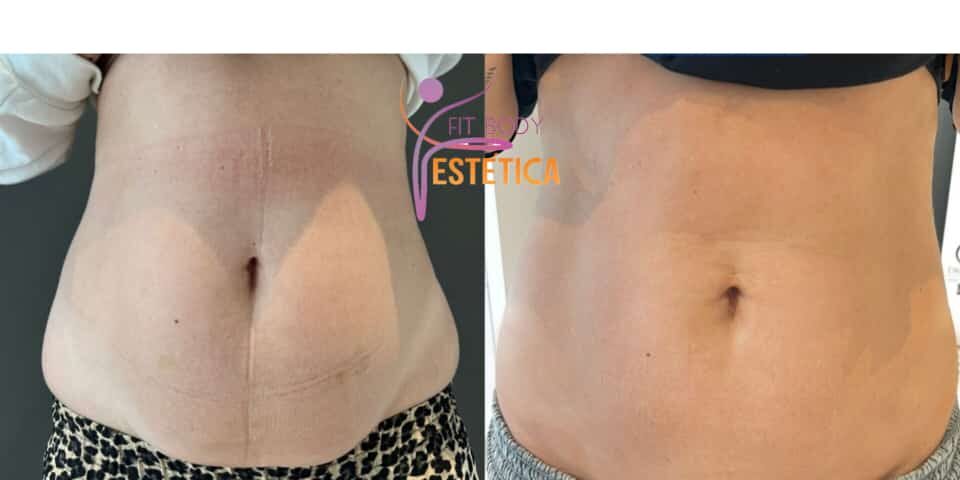 Tratamento Para Gordura Localizada E Emagrecimento Cl Nica Fit Body