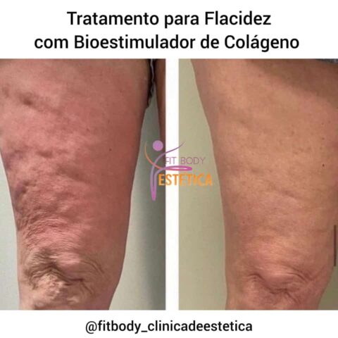 Tratamento Para Flacidez Bioestimulador De Col Geno Cl Nica Fit