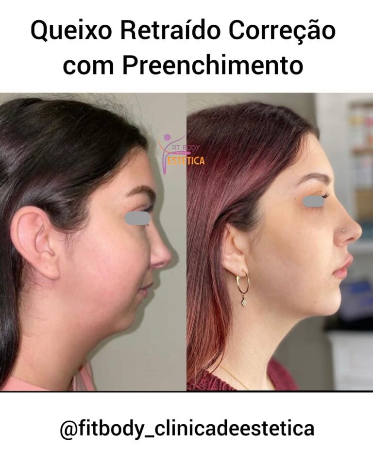 Queixo Retraído Correção Preenchimento Clínica Fit Body Estética