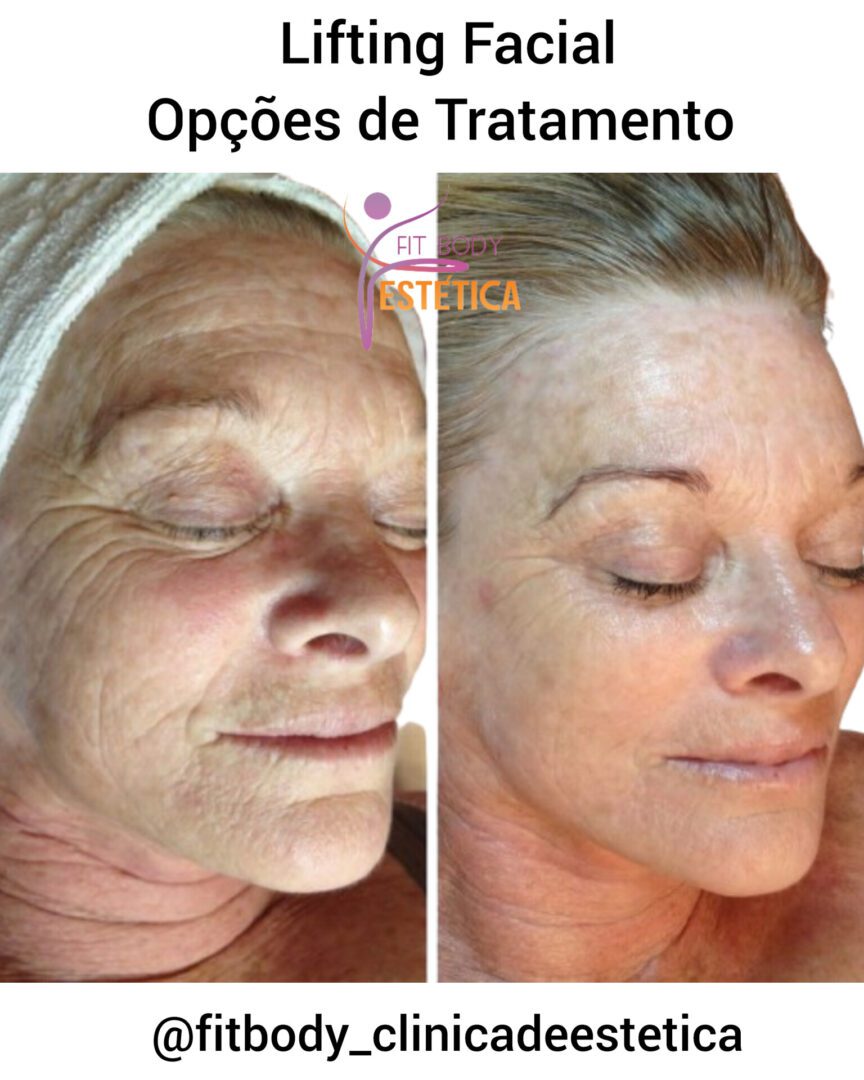 Lifting Facial Opções de Tratamento Clínica Fit Body Estética