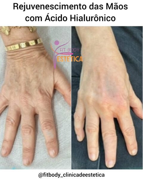 Rejuvenescimento Das M Os Cido Hialur Nico Cl Nica Fit Body Est Tica