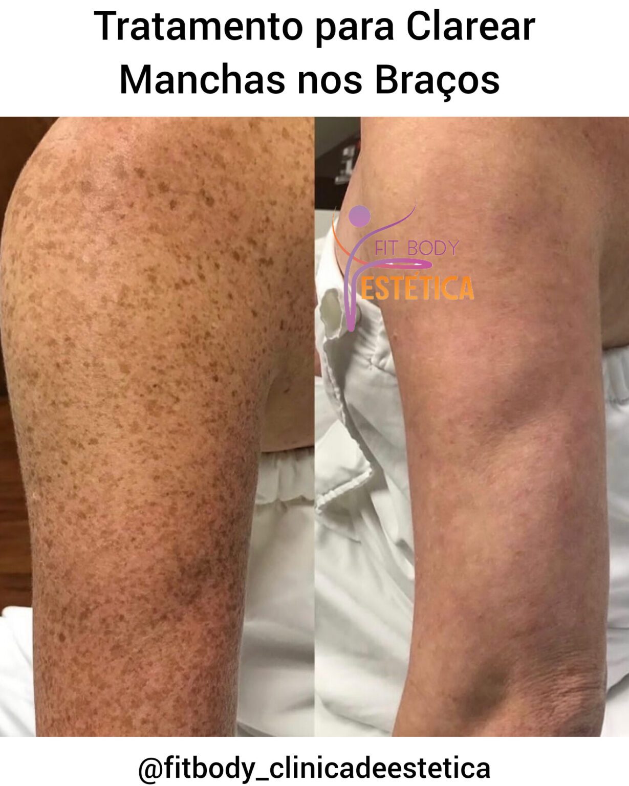 Saiba Como Tratar Clarear Manchas Nos Bra Os Cl Nica Fit Body Est Tica