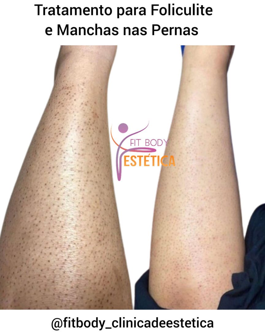 Tratamento para Foliculite e Manchas nas Pernas Clínica Fit Body Estética