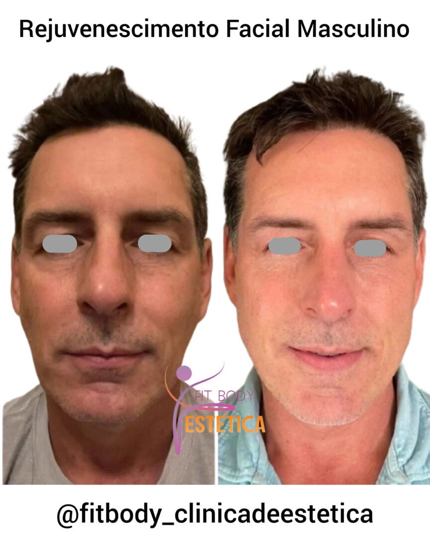 Tratamentos para Rejuvenescimento Facial Masculino Clínica Fit Body