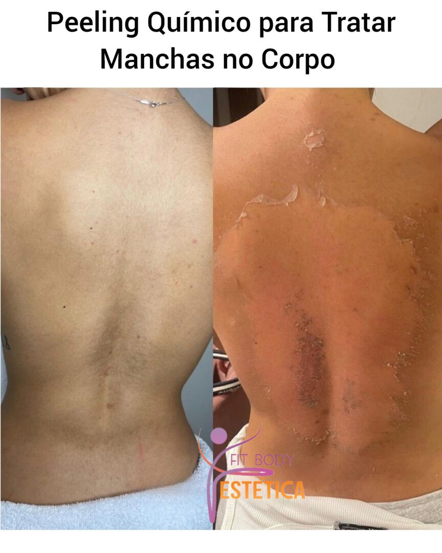 Tratamento Para Manchas No Corpo Cl Nica Fit Body Est Tica