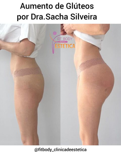 Aumento de Glúteos por Dra Sacha Silveira Clínica Fit Body Estética