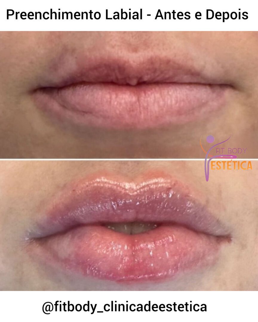 Antes E Depois Preenchimento Labial Cl Nica Fit Body Est Tica