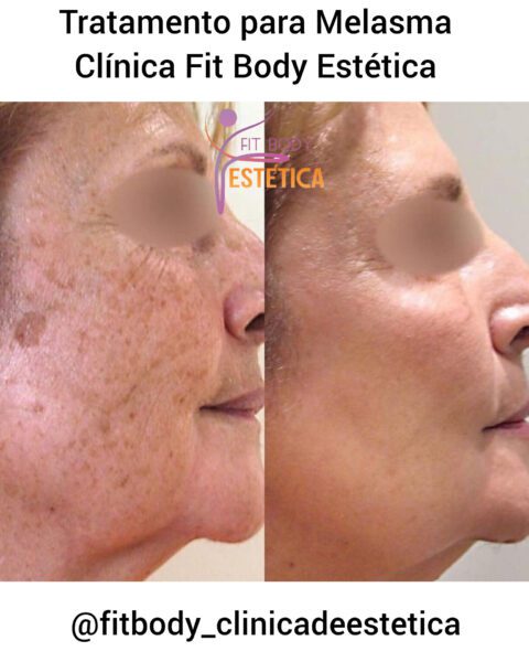 Tratamento para Melasma Clínica Fit Body Clínica Fit Body Estética