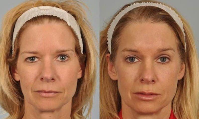 Botox para Levantar as Sobrancelhas - Clínica Fit Body Estética