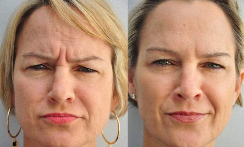 botox para tratar as rugas da glabela
