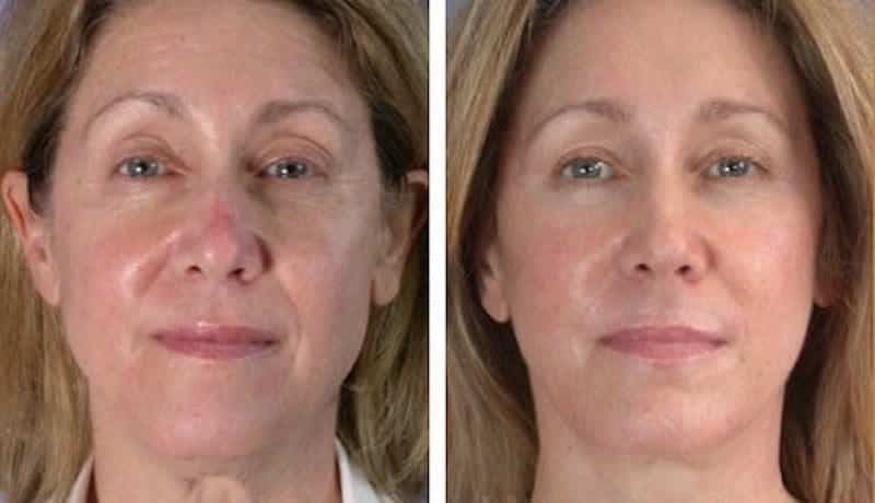 dysport antes e depois