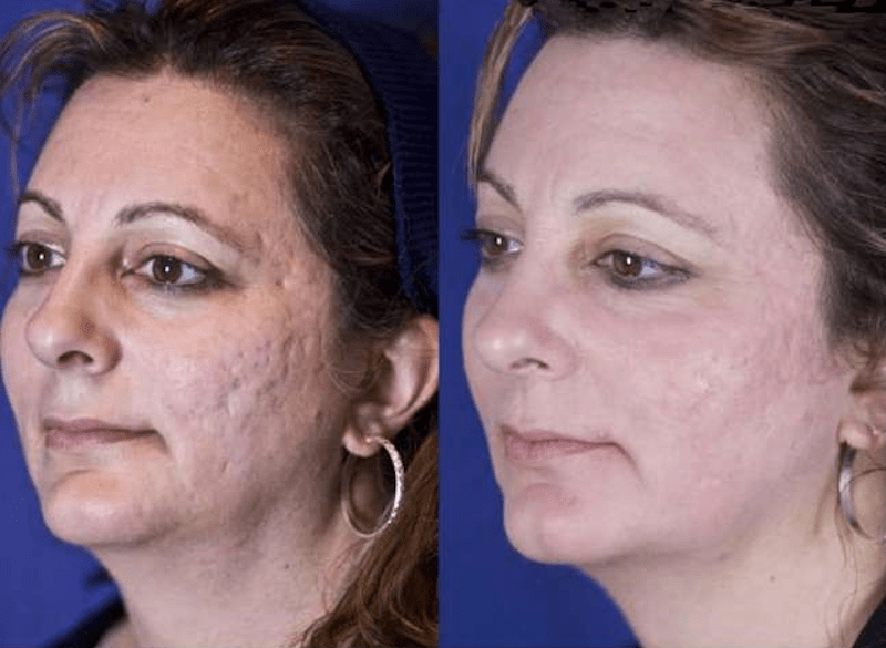 antes e depois cicatriz de acne12