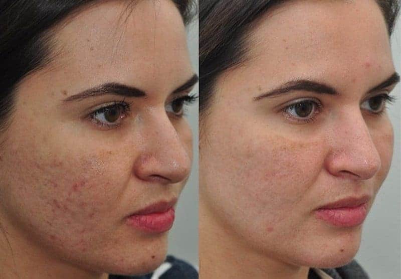 cicatriz de acne56