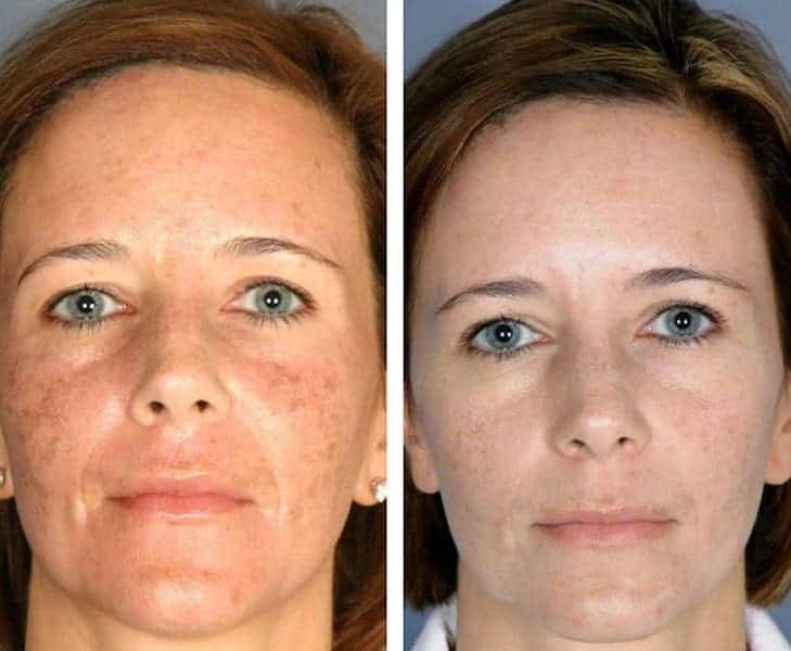 melasma tratamento