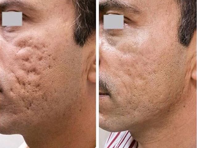 Microagulhamento Antes E Depois Para Cicatriz De Acne 9270