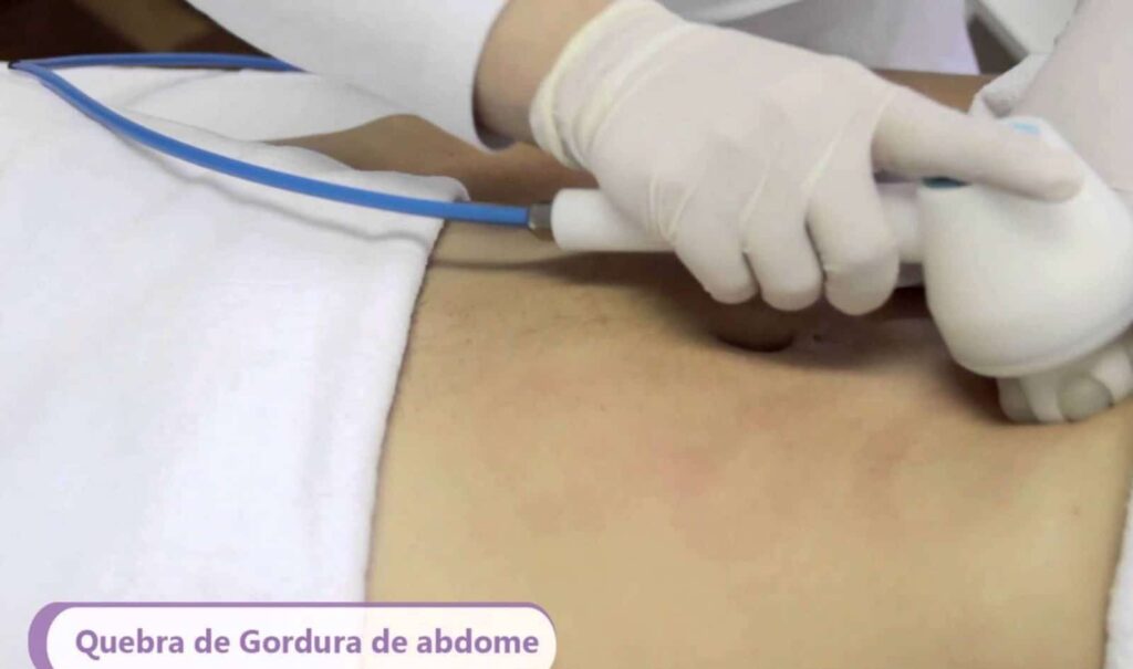 Endermoterapia para Gordura Localizada