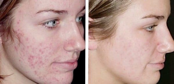 Tratamento para Acne e Manchas de Acne - Fit Body Estética - Tratamento