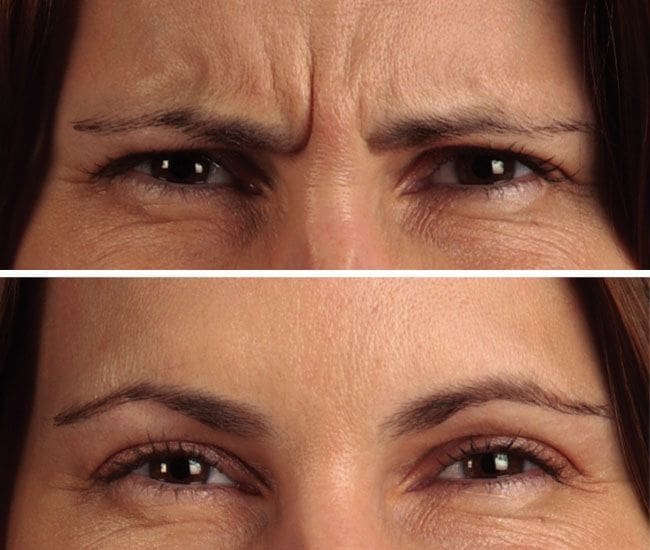 botox antes depois