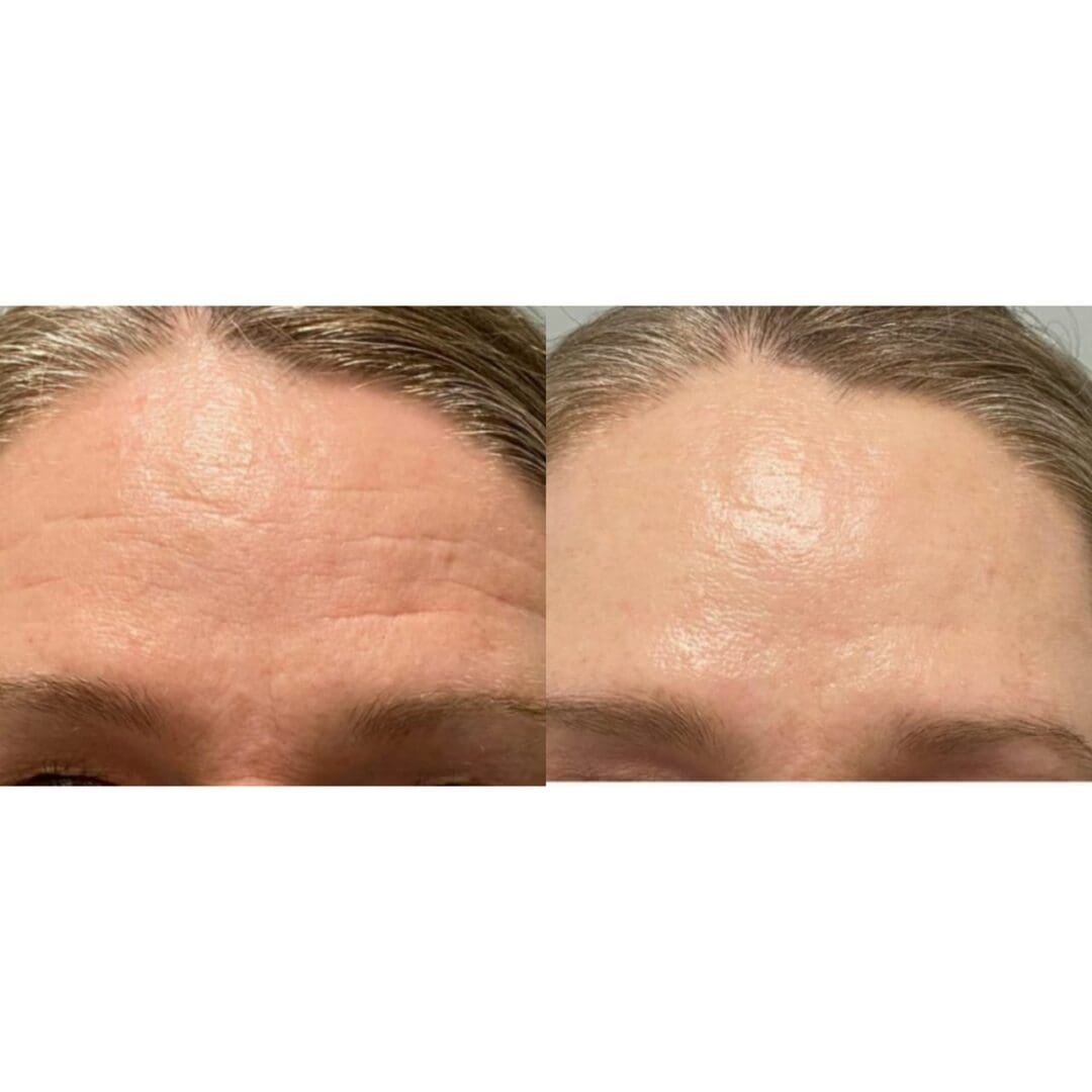 Preenchimento De Linhas De Expressão Na Testa Linhas de Expressão na Testa - Tratamento com Botox