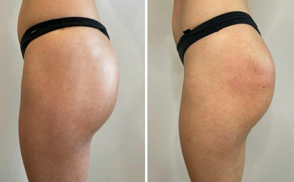 Harmonizacao de Gluteo Sao Paulo