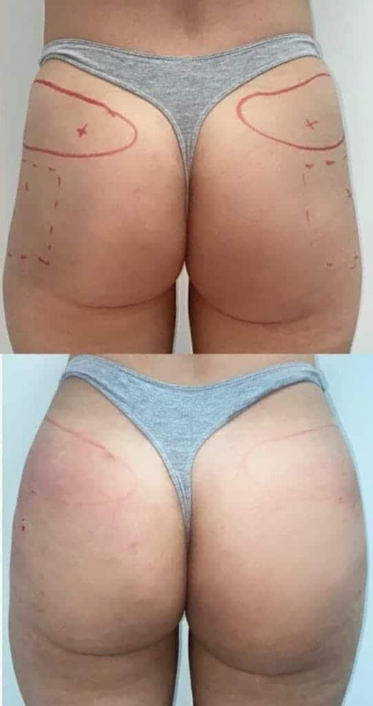 Preenchimento de Quadril Antes e Depois