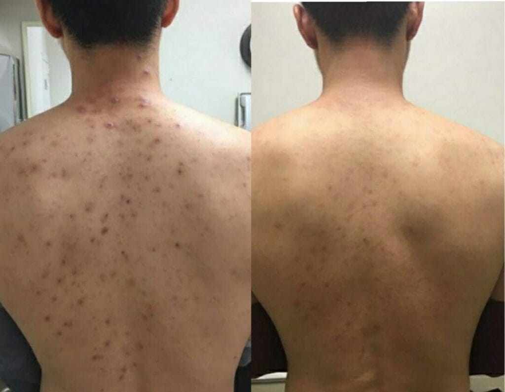 Manchas nas Costas Tratamento