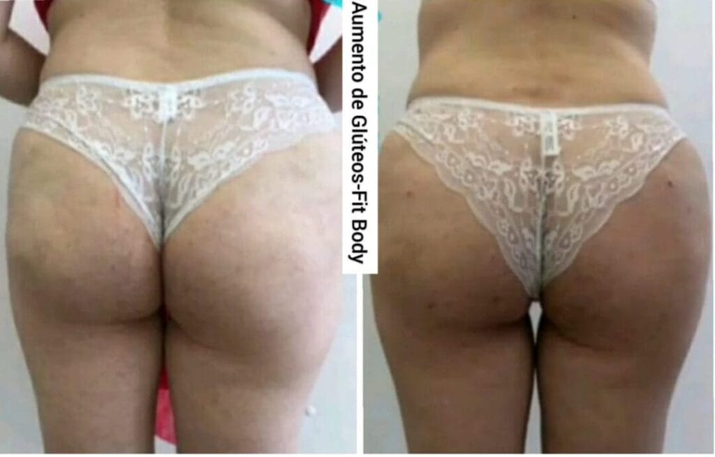 Antes e Depois Aumento de Gluteo