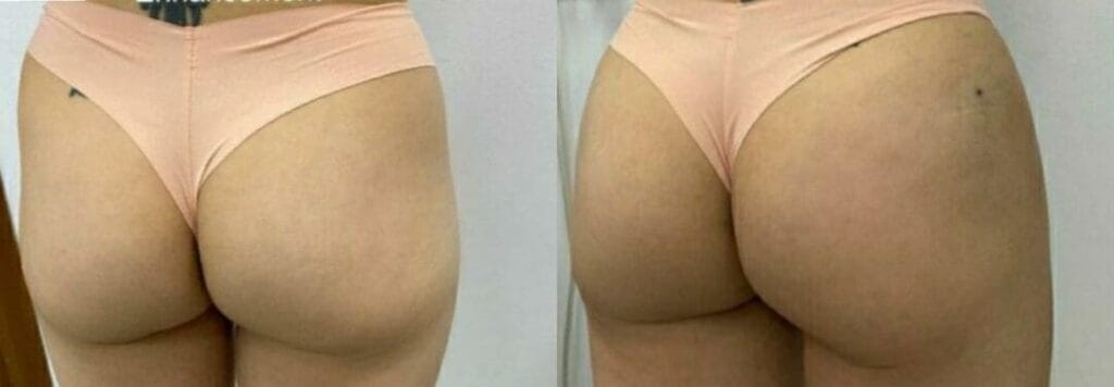 Clinica Especializada em Preenchimento de Gluteo