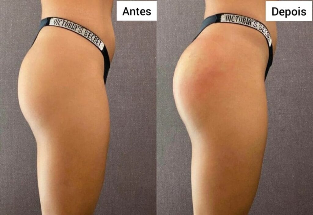 Remodelacao dos Gluteos