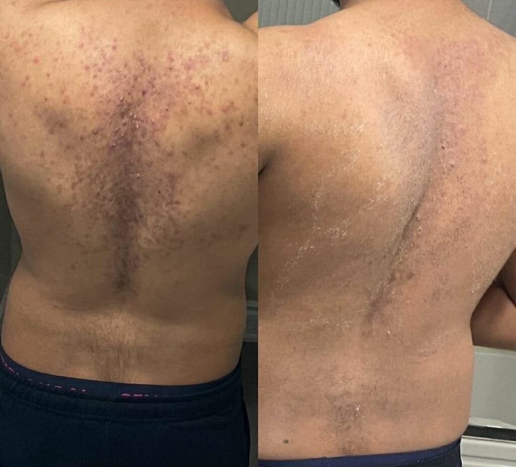 Tratamento para Manchas de Acne Antes e Depois