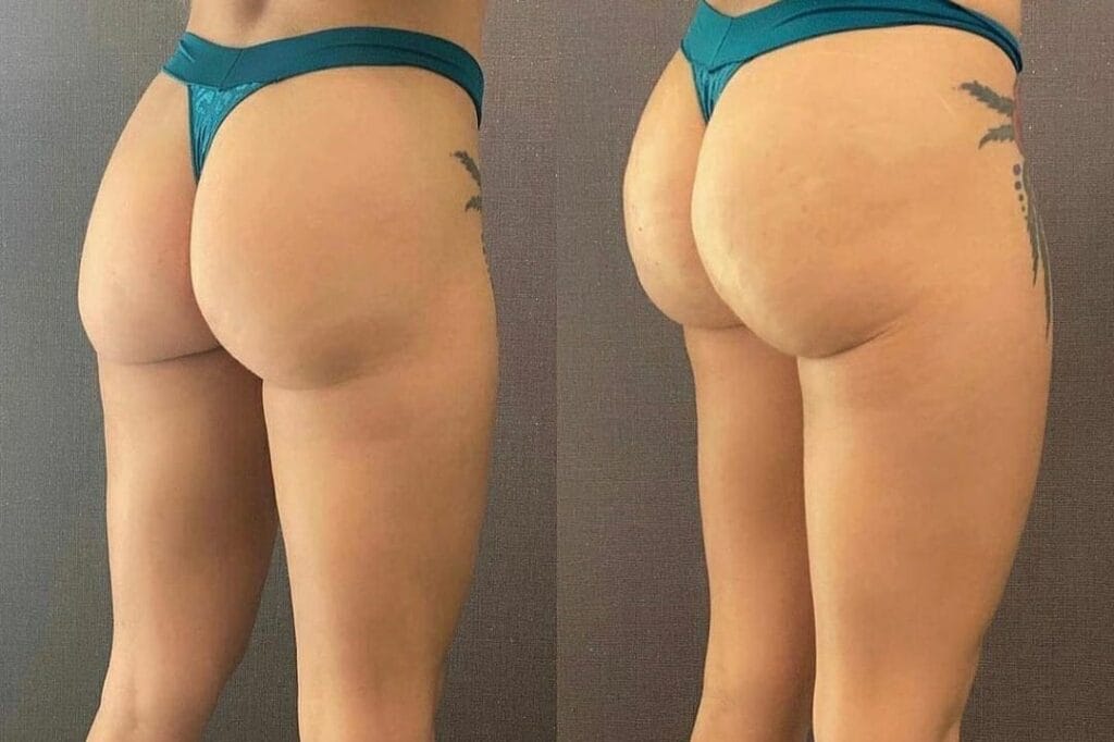 Tratamento para Modelar e Aumentar Gluteo