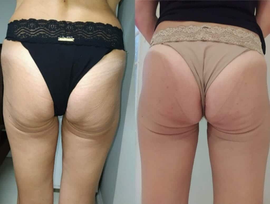 Tratamento para Gluteo Flacido