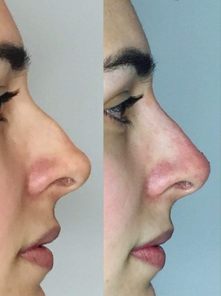 Antes e Depois Harmonizacao do Nariz