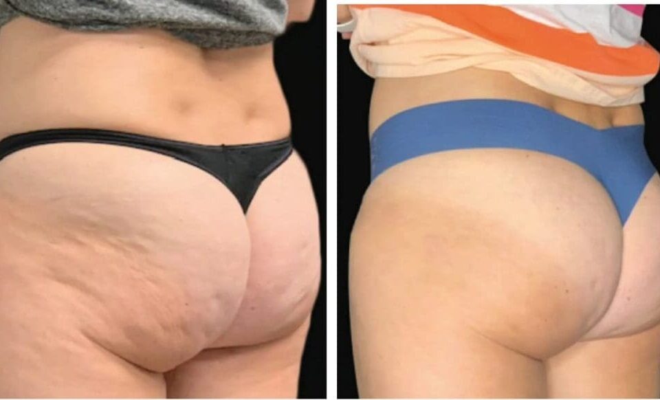 Antes e Depois do Tratamento para Celulite