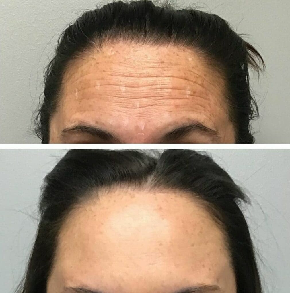 Aplicação de Botox no Rosto Antes e Depois