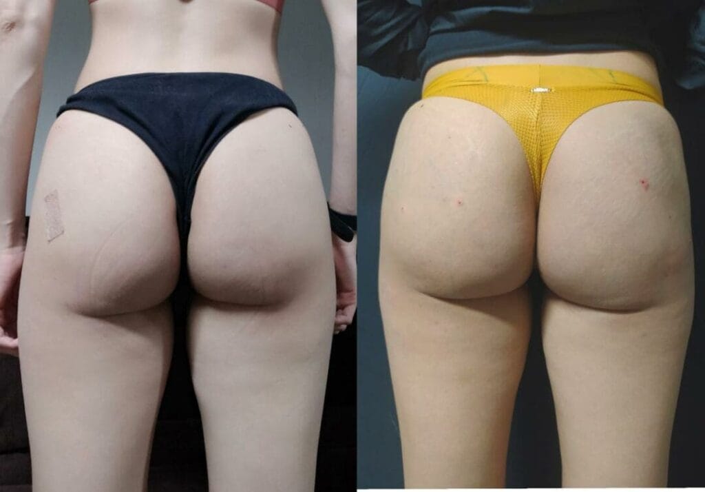 Bioestimulador de Colágeno no Glúteo