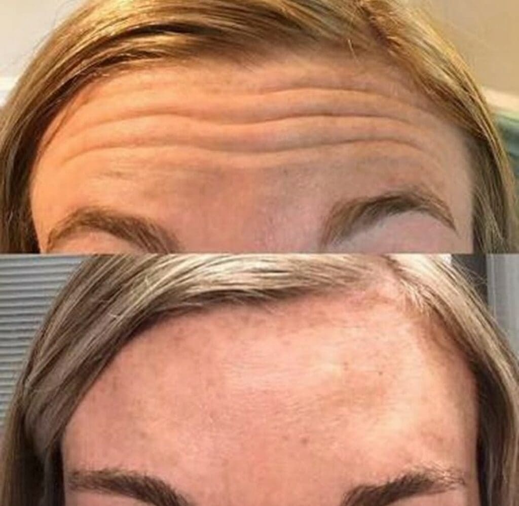 Botox no Rosto Antes e Depois