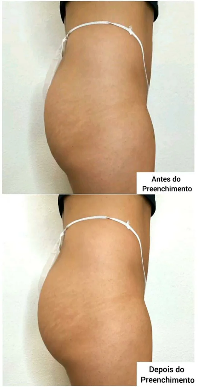 Procedimentos para Aumentar Glúteo: Saiba Mais (11) 9-8949-3747 Para  Aumentar os Glúteos sem recorrer a cirurgia plástica, indicamos a  Hidroxiapatita