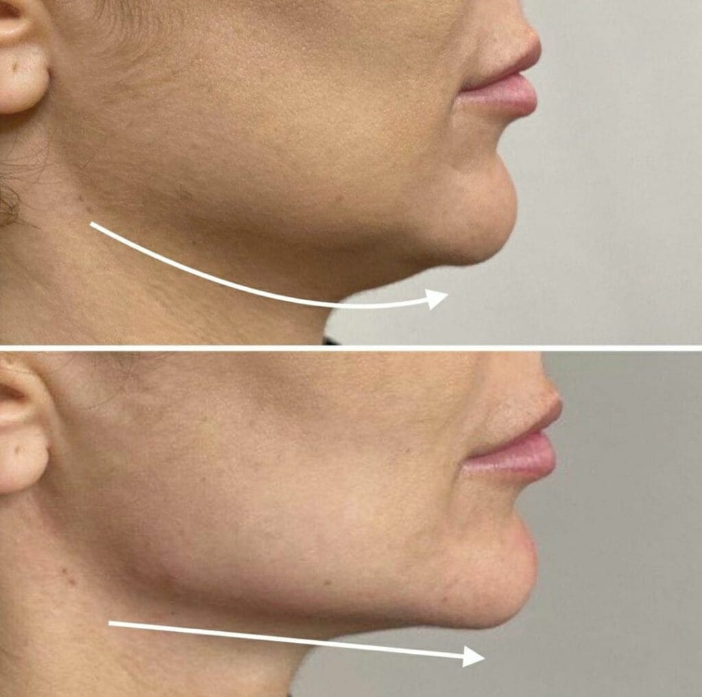 Harmonizacao Facial