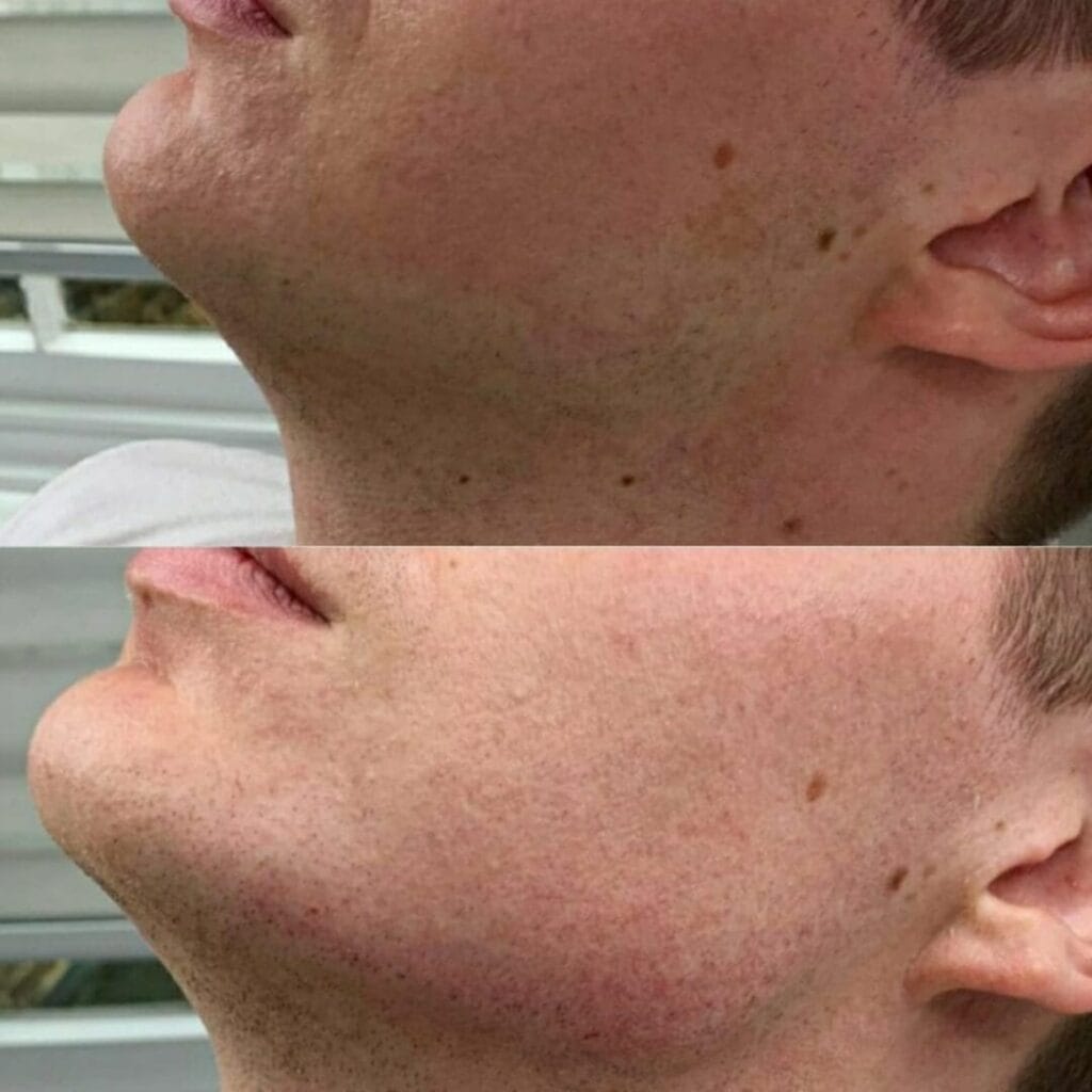 Harmonização do Rosto para Rejuvenescer