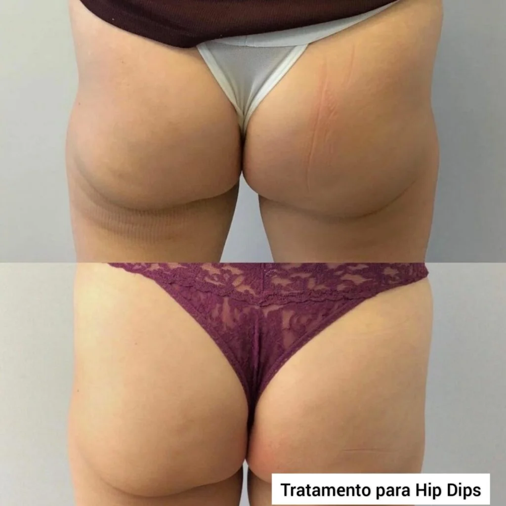 Hip Dips Antes e Depois do - Clínica Fit Body Estética